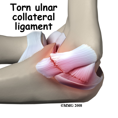 elbow_ucl_injury_causes01